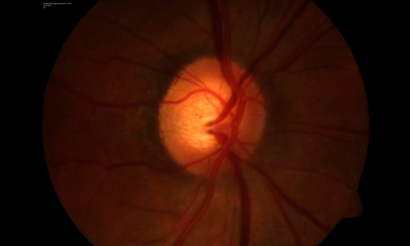 Especializada Glaucoma